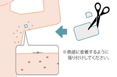 麻酔テープの貼り方